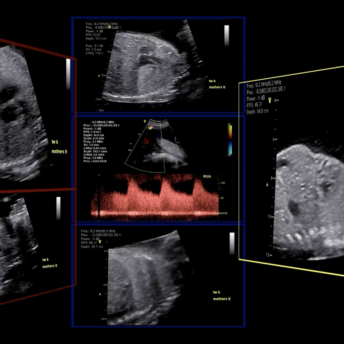 Ultrasonido de crecimiento y Doppler fetal
